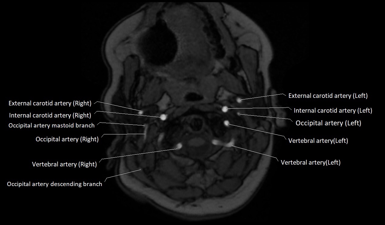 Carotid artery anatomy axial 3T image 11.jpg